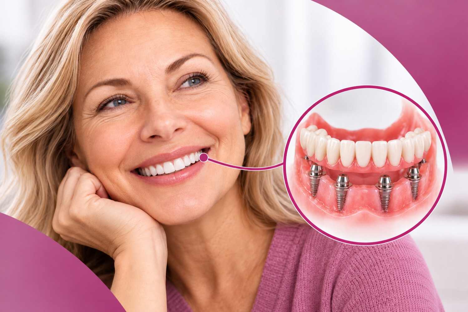 Multiple dental implants